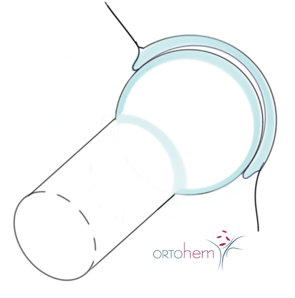 Femoroacetabularni sraz i oštećenje labruma