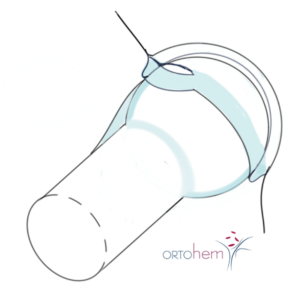 Femoroacetabularni sraz i oštećenje labruma