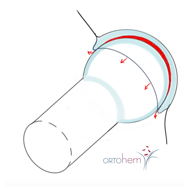 Femoroacetabularni sraz i oštećenje labruma