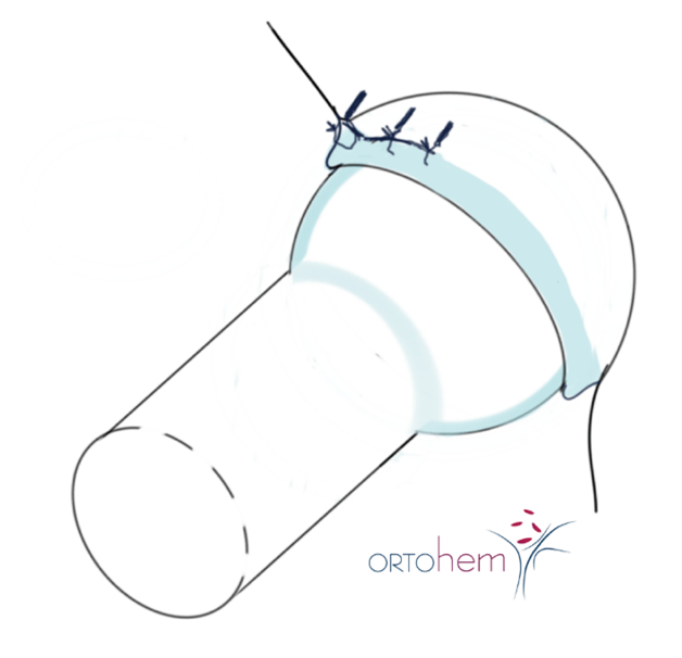 Femoroacetabularni sraz i oštećenje labruma
