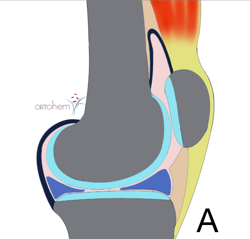 Unutarzglobna aplikacija viskosuplementa - hijaluronske kiseline