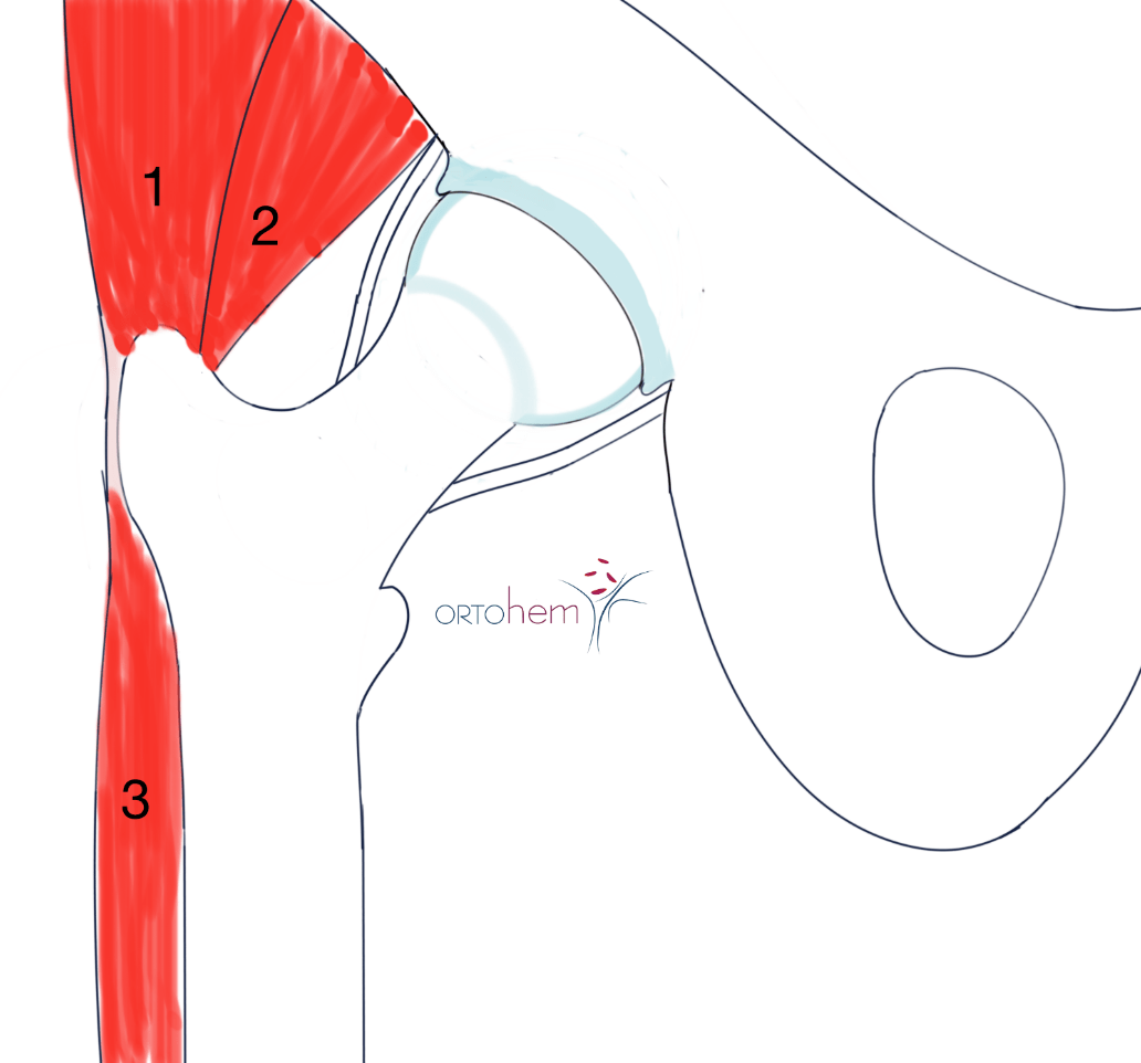 Koksartroza i ugradnja totalne endoproteze (TEP) kuka
