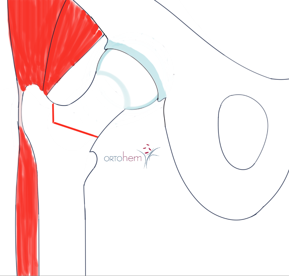 Koksartroza i ugradnja totalne endoproteze (TEP) kuka