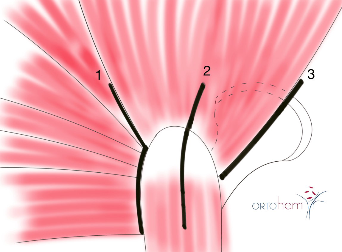 Koksartroza i ugradnja totalne endoproteze (TEP) kuka