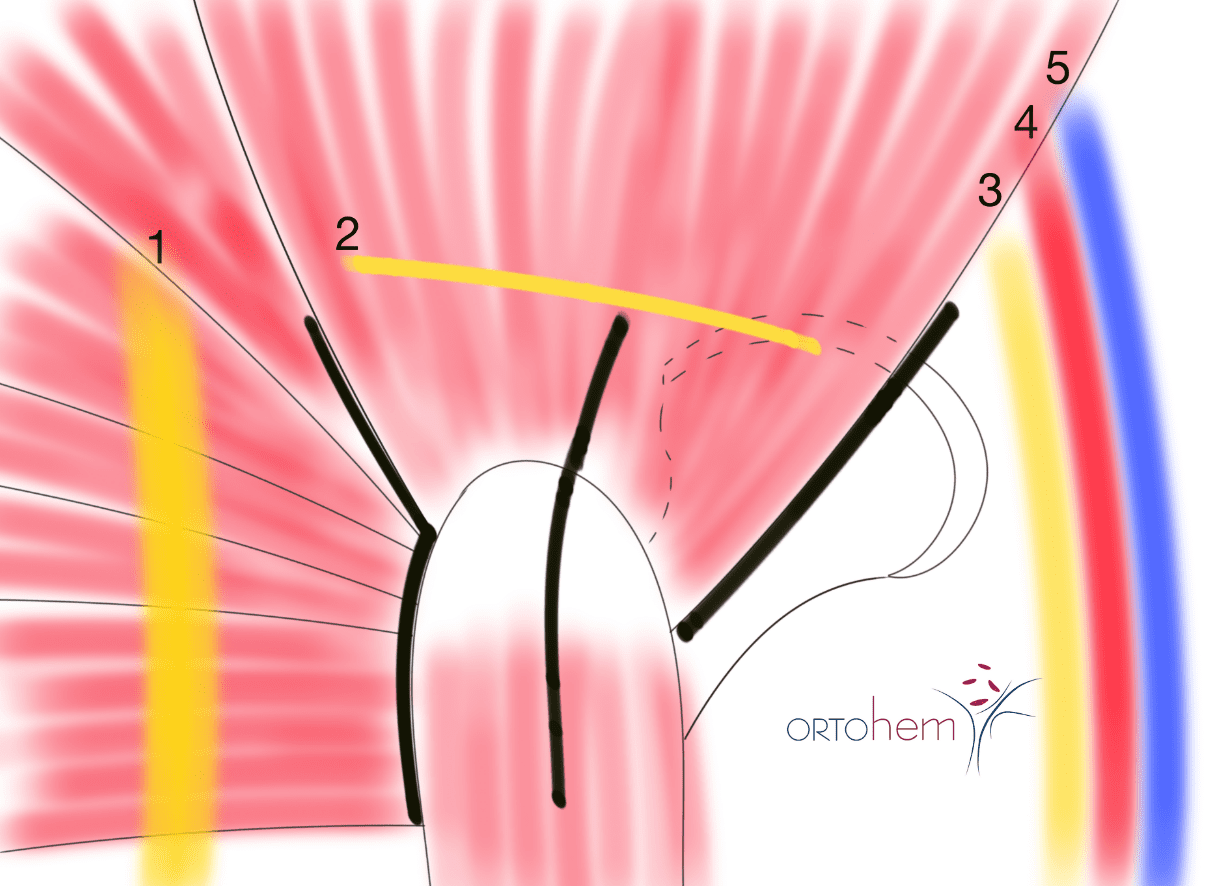 Koksartroza i ugradnja totalne endoproteze (TEP) kuka