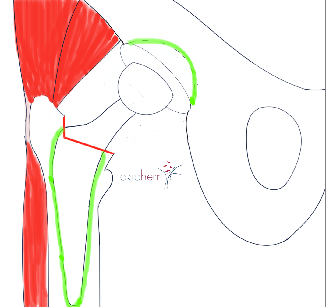 Koksartroza i ugradnja totalne endoproteze (TEP) kuka
