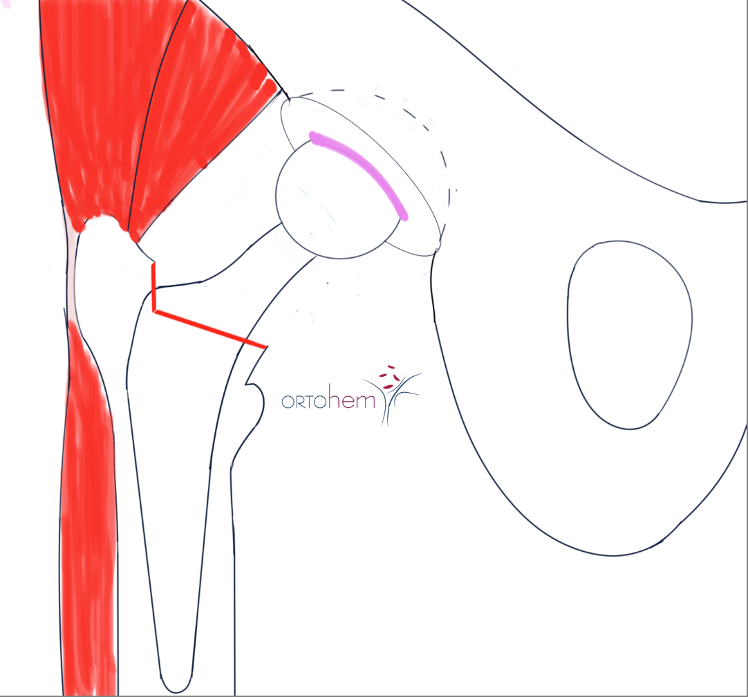 Koksartroza i ugradnja totalne endoproteze (TEP) kuka